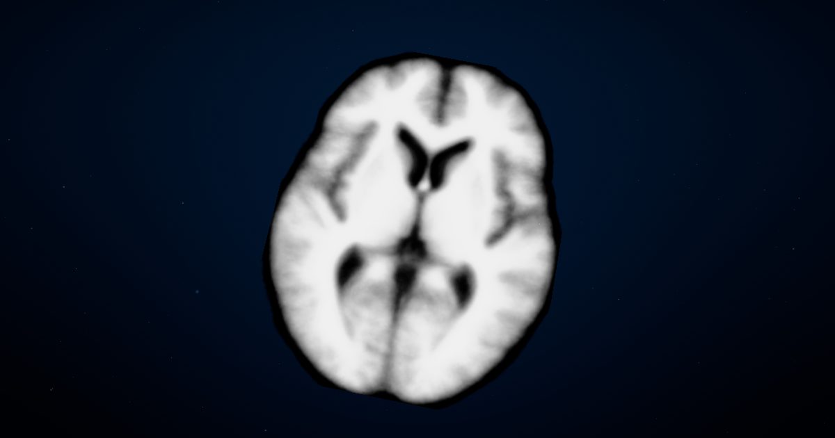 An MRI slice across the head, seen from above